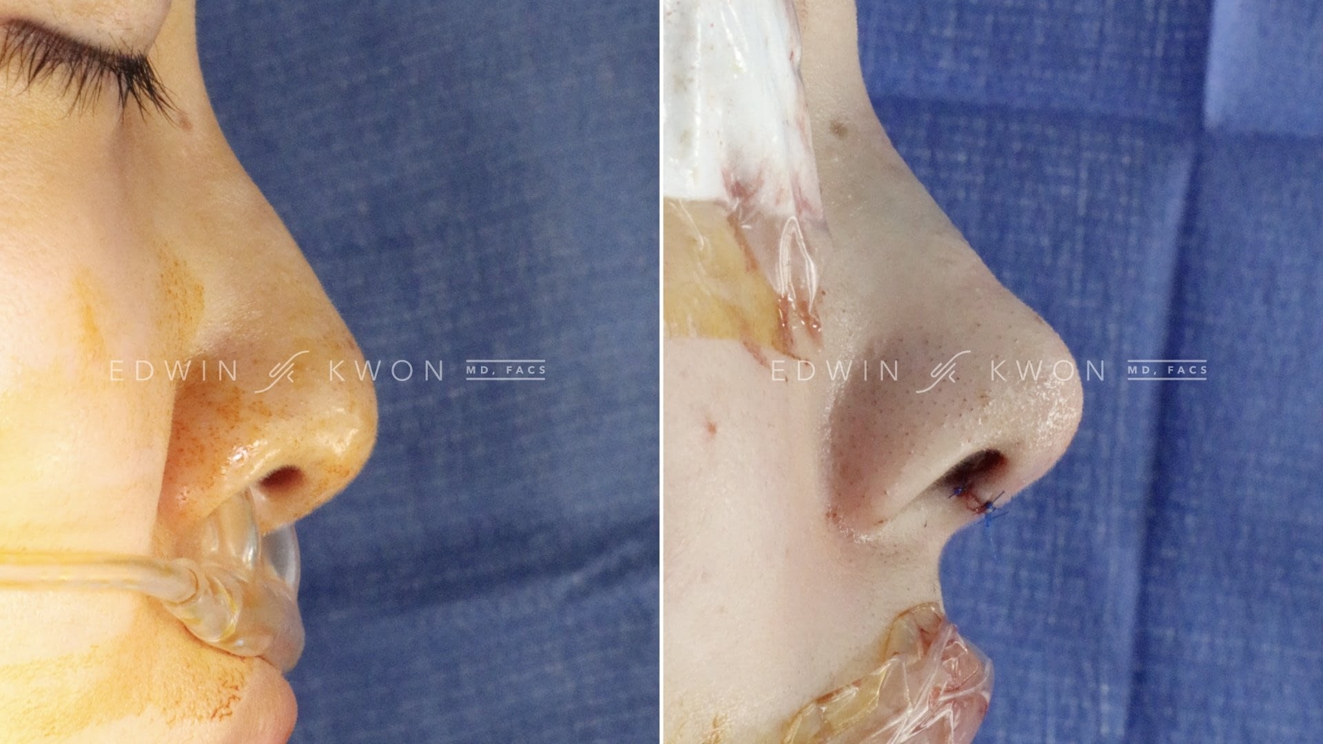 difference between closed and open rhinoplasty