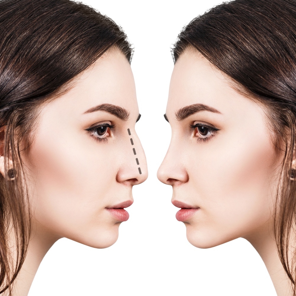 difference between closed and open rhinoplasty